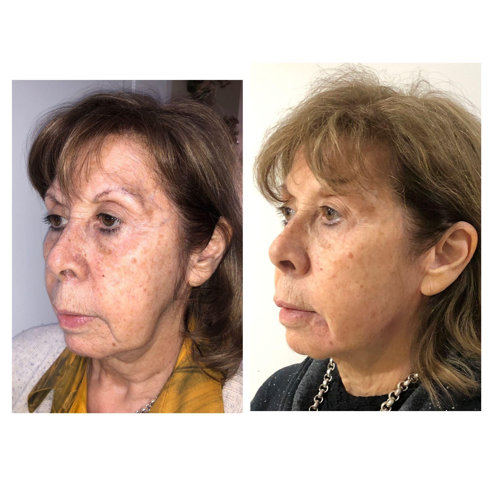 Mujer antes y después de un tratamiento facial