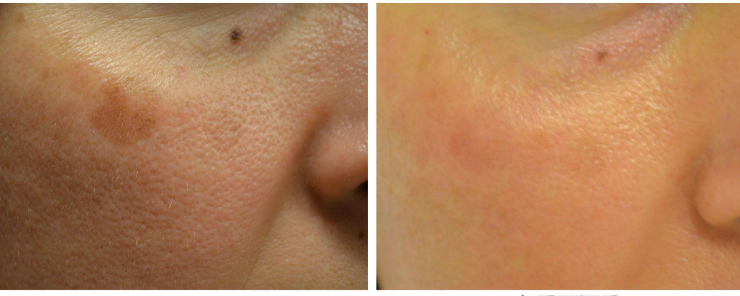Antes y después de un tratamiento de manchas por sobreproducción de Melamina en la piel.