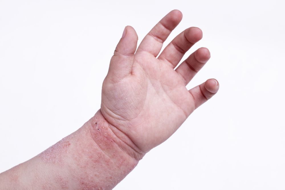 mano de persona con dermatitis
