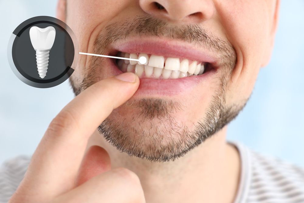 Foto de implante dental en hombre