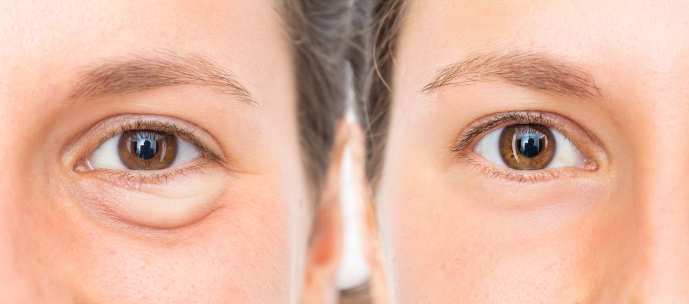antes y después de un rejuvenecimiento en los ojos