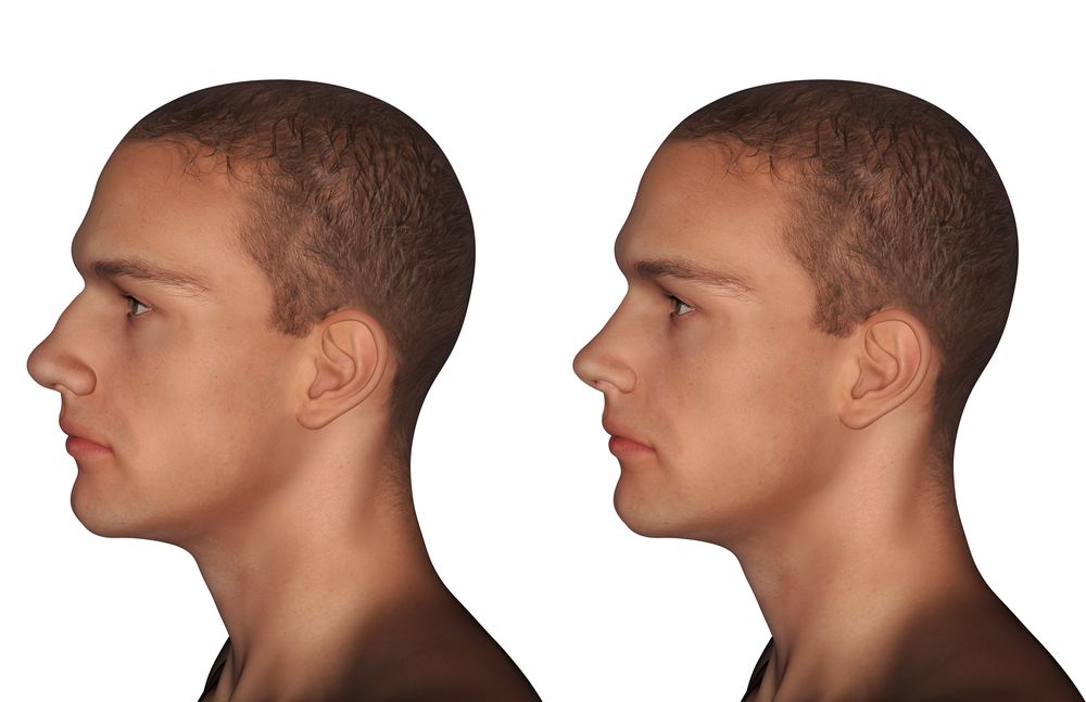 Foto de hombre antes y después de una rinoplastia