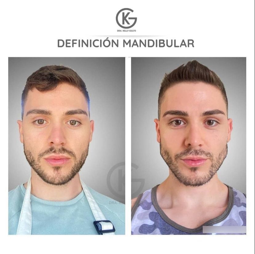 rostro de un chico antes y después de un marcaje mandibular