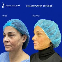 Blefaroplastia - Dra. Daniela Stephania Vaca Grisales