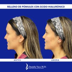 Ácido hialurónico - Dra. Daniela Stephania Vaca Grisales
