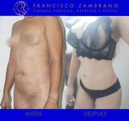 Abdominoplastia y otros tratamientos