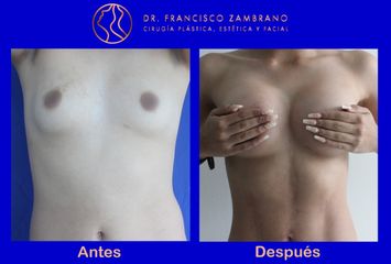 Dr. Francisco Zambrano - Mamoplastia de aumento 