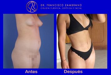 Dr. Francisco Zambrano - Liposuccion, lipoinyeccion glutea, marcacion abdominal