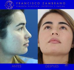 Dr. Francisco Zambrano - Rinoplastia