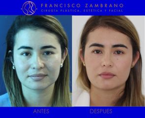 Dr. Francisco Zambrano - Rinoplastia