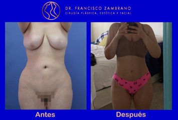 Dr. Francisco Zambrano - Eliminacion de fibrosis , pexia mamaria lipoinyeccion glutea