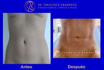 Liposuccion, lipoinyección glútea, marcación abdominal - Dr. Francisco Zambrano