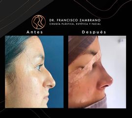 Rinoplastia - Dr. Francisco Zambrano