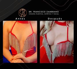 Mamoplastia de aumento - Dr. Francisco Zambrano