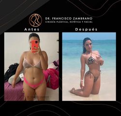 Liposucción - Dr. Francisco Zambrano