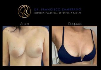 Mamoplastia de aumento - Dr. Francisco Zambrano