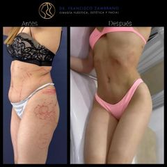 Liposucción - Dr. Francisco Zambrano