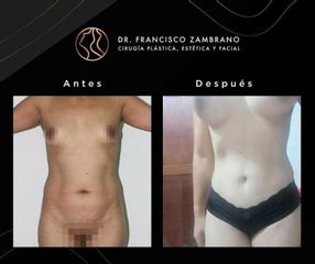 Abdominoplastia - Dr. Francisco Zambrano