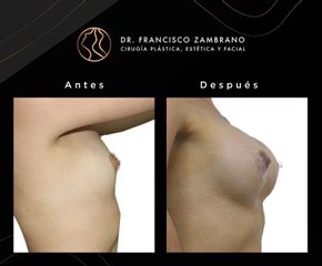 Mamoplastia de Aumento - Dr. Francisco Zambrano