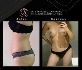 Liposucción - Dr. Francisco Zambrano
