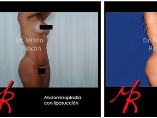 Ates y despues de abdominoplastia con liposuccion