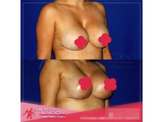 Mamoplastia de aumento 