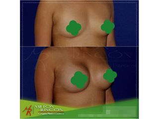 Mamoplastia de aumento 