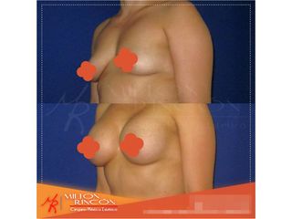 Mamoplastia de aumento 