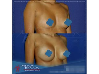 Mamoplastia de aumento 