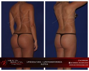 Lipotransferencia