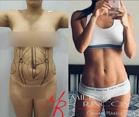 Liposucción - Dr. Milton Rincón Carranza