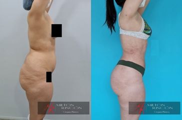 Liposucción - Dr. Milton Rincón Carranza
