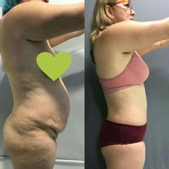 Abdominoplastia - Dr. Jose Alfredo Burgos