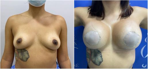 Mamoplastia de aumento - Dr. Jose Alfredo Burgos