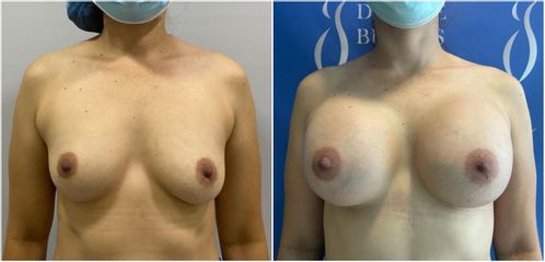 Mamoplastia de aumento - Dr. Jose Alfredo Burgos