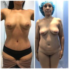 Abdominoplastia - Dr. Jose Alfredo Burgos