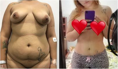 Abdominoplastia - Dr. Jose Alfredo Burgos