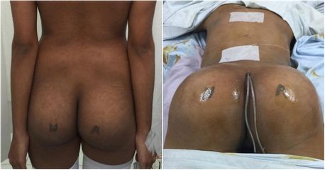 Gluteoplastia - Dr. Jose Alfredo Burgos