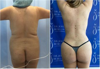 Liposucción - Dr. Jose Alfredo Burgos