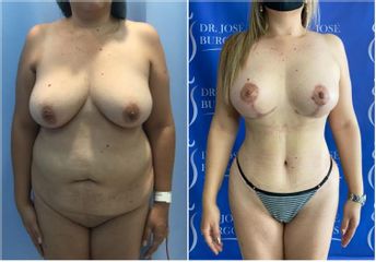 Lipoescultura - Dr. Jose Alfredo Burgos
