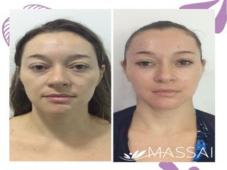 Tratamiento Rejuvenecimiento Facial y Porcelanización