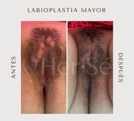 Labioplastia - Her Sé