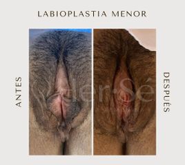 Labioplastia - Her Sé
