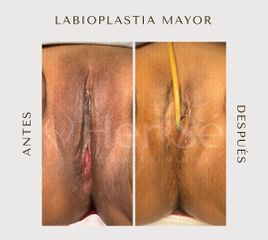 Labioplastia - Her Sé