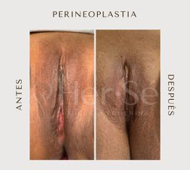 Perineoplastia - Her Sé