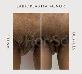 Labioplastia - Her Sé