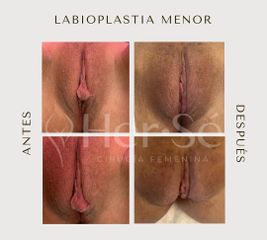 Labioplastia - Her Sé
