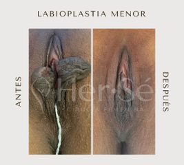 Labioplastia - Her Sé