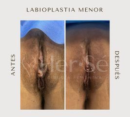 Labioplastia - Her Sé