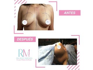 Antes y después de aumento de busto